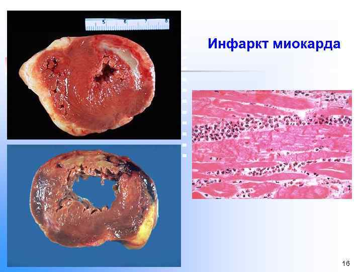 Инфаркт миокарда 16 