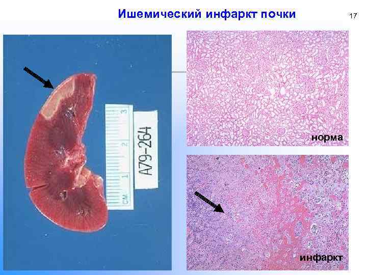 Ишемический инфаркт почки 17 норма инфаркт 