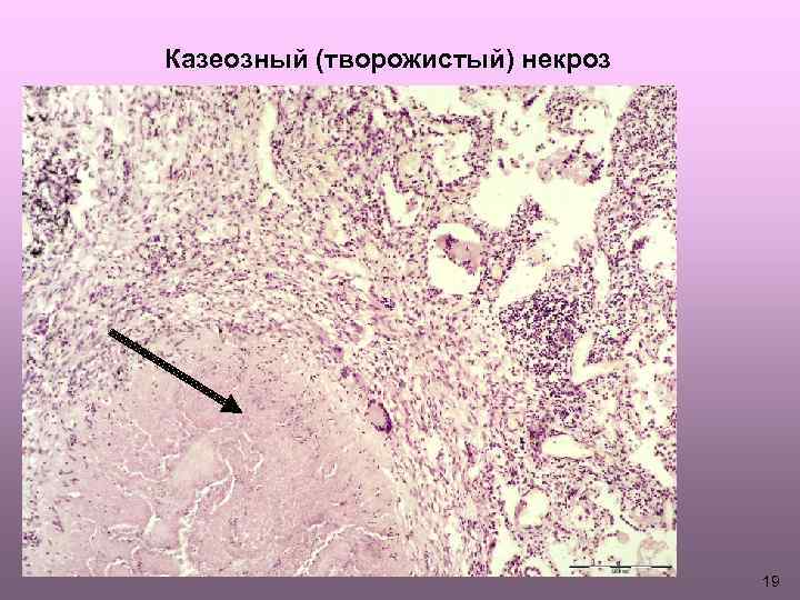 Казеозный (творожистый) некроз 19 