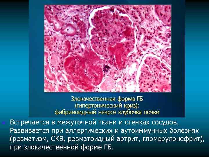 n Встречается в межуточной ткани и стенках сосудов. Развивается при аллергических и аутоиммунных болезнях