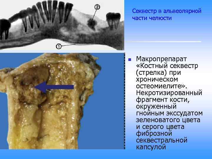 Секвестр в альвеолярной части челюсти n Макропрепарат «Костный секвестр (стрелка) при хроническом остеомиелите» .