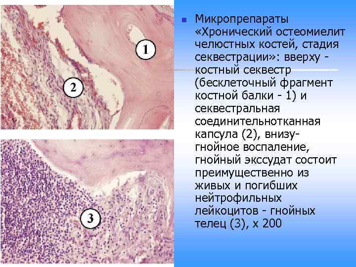 n Микропрепараты «Хронический остеомиелит челюстных костей, стадия секвестрации» : вверху - костный секвестр (бесклеточный