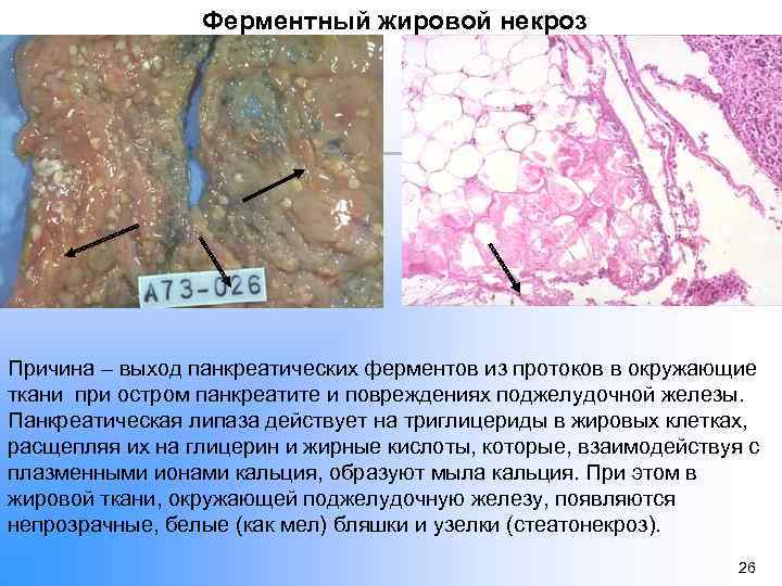 Ферментный жировой некроз Причина – выход панкреатических ферментов из протоков в окружающие ткани при