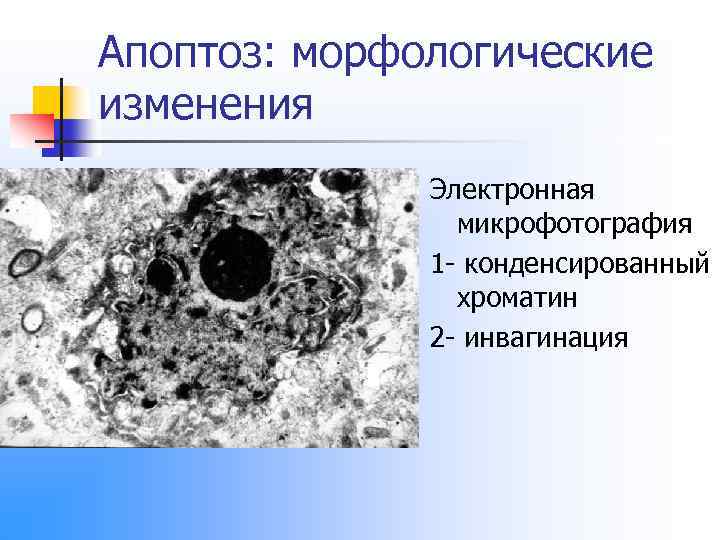 Апоптоз: морфологические изменения Электронная микрофотография 1 - конденсированный хроматин 2 - инвагинация 