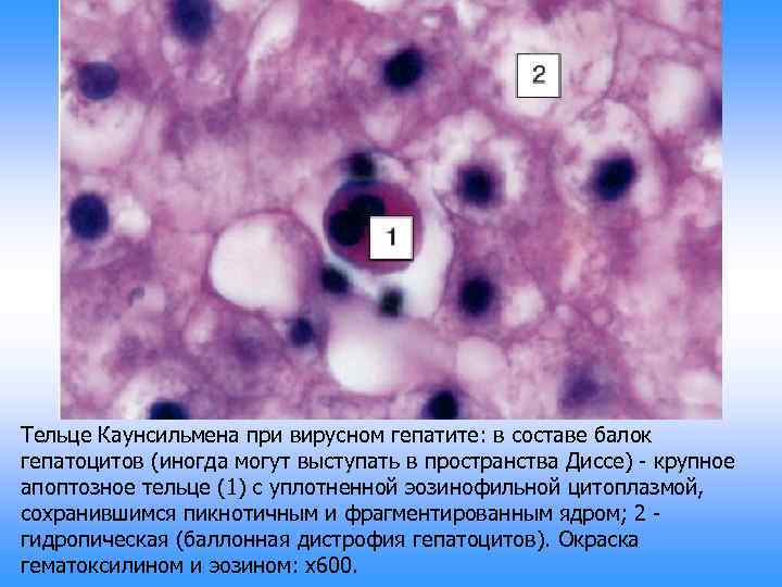 Тельце Каунсильмена при вирусном гепатите: в составе балок гепатоцитов (иногда могут выступать в пространства