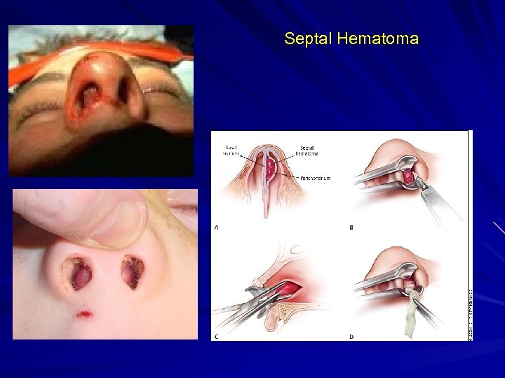 Septal Hematoma 