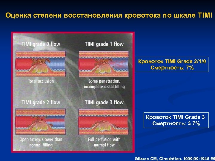 Оценка степени восстановления кровотока по шкале TIMI Кровоток TIMI Grade 2/1/0 Смертность: 7% Кровоток