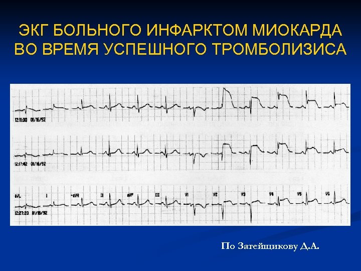 ЭКГ БОЛЬНОГО ИНФАРКТОМ МИОКАРДА ВО ВРЕМЯ УСПЕШНОГО ТРОМБОЛИЗИСА По Затейщикову Д. А. 