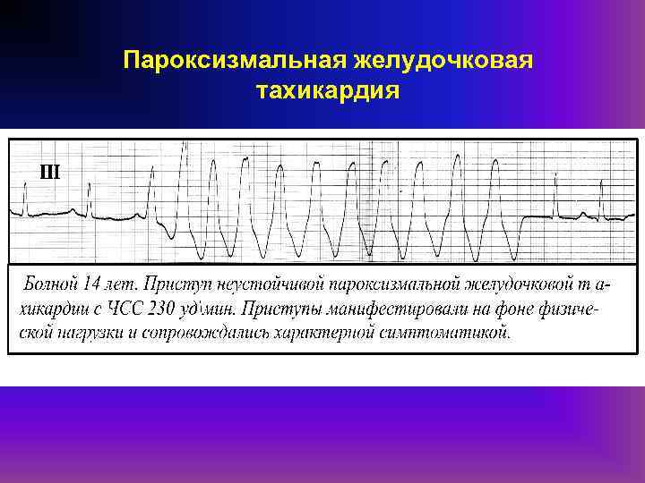 Пароксизмальная желудочковая тахикардия карта вызова смп