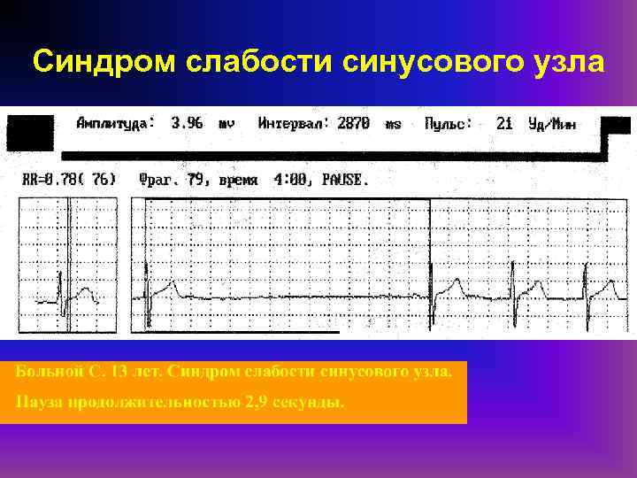 Синдром слабости синусового узла код мкб 10