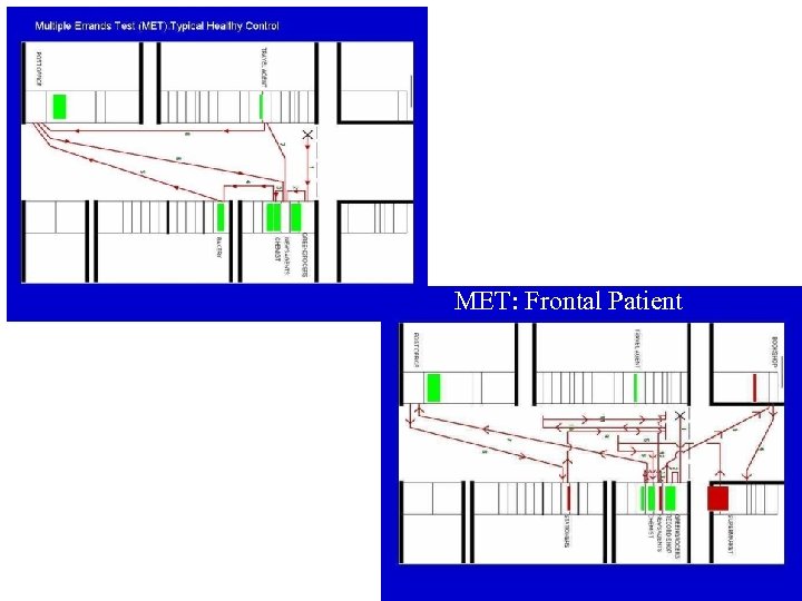 MET: Frontal Patient 
