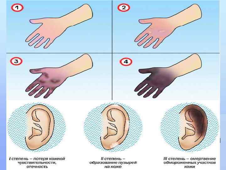 3 степень - происходит омертвление всех слоев кожи, пузыри наполнены темной жидкостью, кожа чернеет.