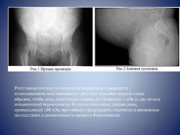 Рентгенологические исследования беременных проводятся с использованием всех возможных средств и способов защиты таким образом,