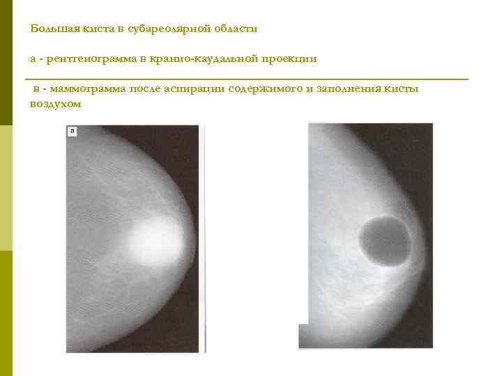 Большая киста в субареолярной области а - рентгенограмма в кранио-каудальной проекции в - маммограмма