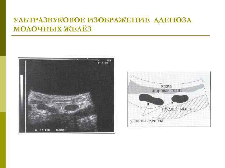 УЛЬТРАЗВУКОВОЕ ИЗОБРАЖЕНИЕ АДЕНОЗА МОЛОЧНЫХ ЖЕЛЁЗ 