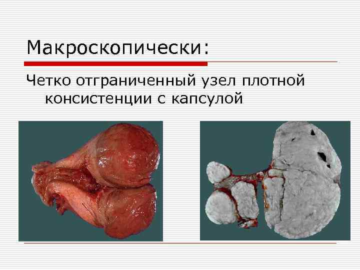 Макроскопически: Четко отграниченный узел плотной консистенции с капсулой 