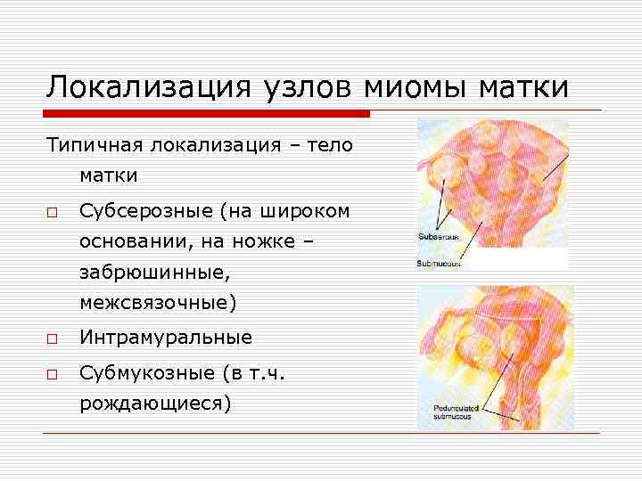 Локализация узлов миомы матки Типичная локализация – тело матки o Субсерозные (на широком основании,