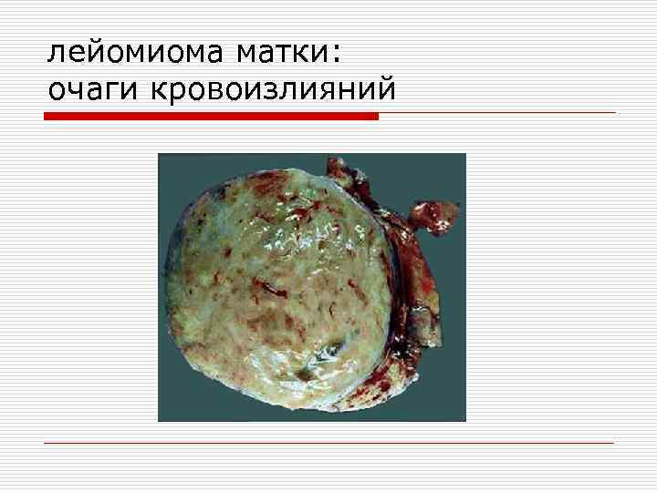 лейомиома матки: очаги кровоизлияний 