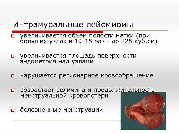 Интрамуральные лейомиомы o увеличивается объем полости матки (при больших узлах в 10 -15 раз