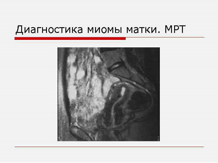 Диагностика миомы матки. МРТ 