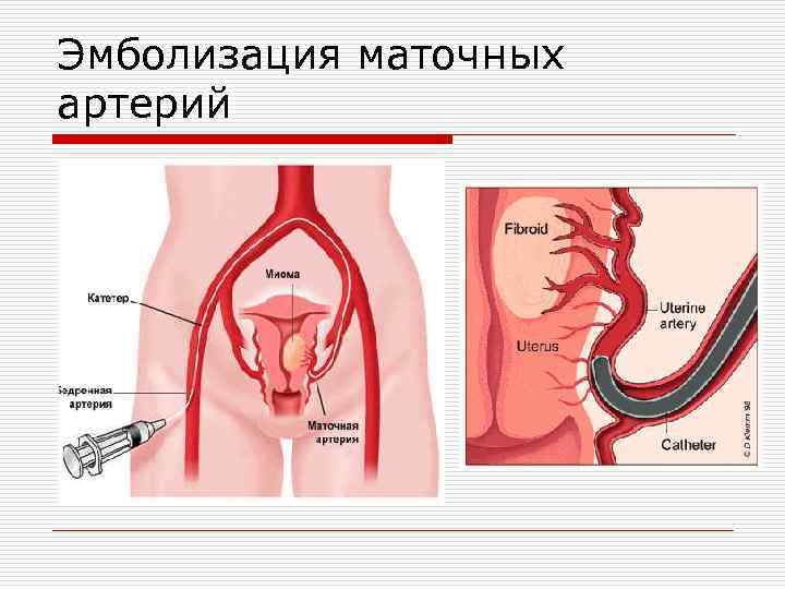 Эмболизация маточных артерий 