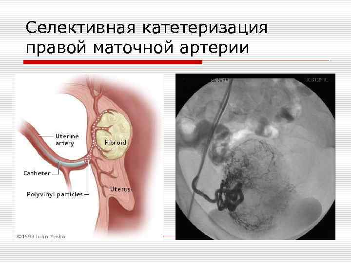 Селективная катетеризация правой маточной артерии 