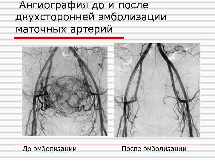 Ангиография до и после двухсторонней эмболизации маточных артерий До эмболизации После эмболизации 