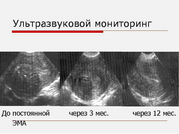 Ультразвуковой мониторинг До постоянной ЭМА через 3 мес. через 12 мес. 