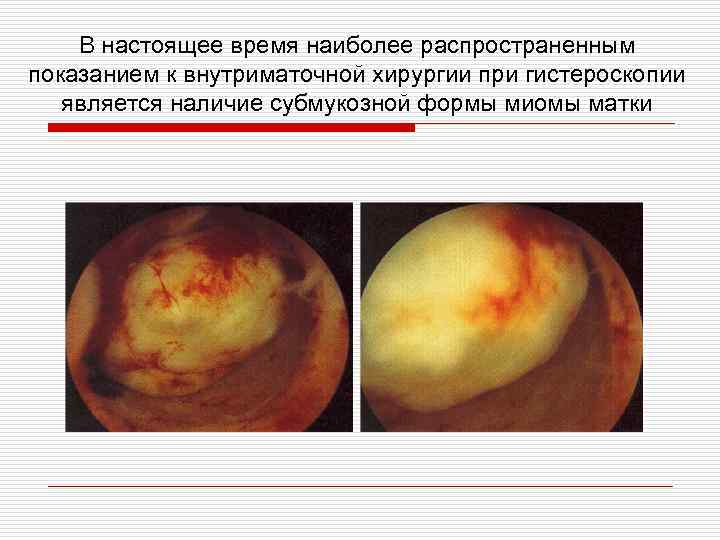 В настоящее время наиболее распространенным показанием к внутриматочной хирургии при гистероскопии является наличие субмукозной