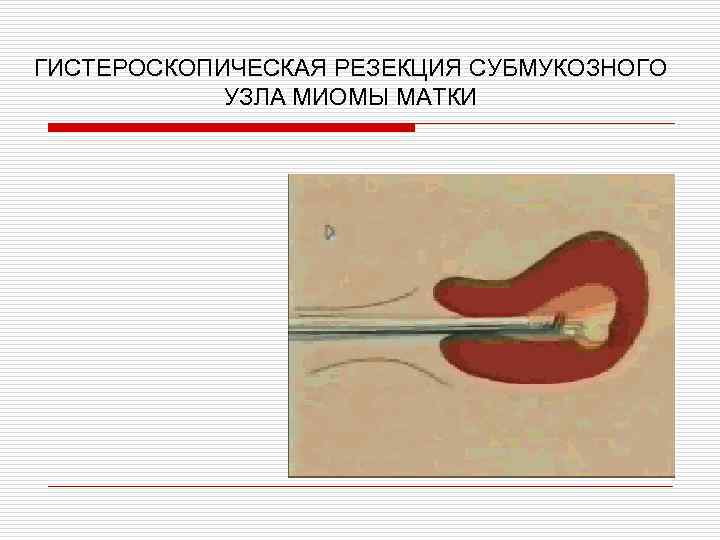 ГИСТЕРОСКОПИЧЕСКАЯ РЕЗЕКЦИЯ СУБМУКОЗНОГО УЗЛА МИОМЫ МАТКИ 