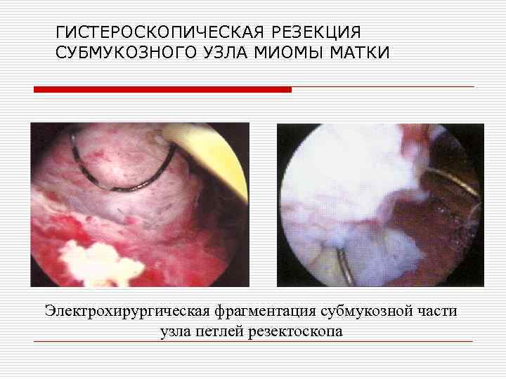 ГИСТЕРОСКОПИЧЕСКАЯ РЕЗЕКЦИЯ СУБМУКОЗНОГО УЗЛА МИОМЫ МАТКИ Электрохирургическая фрагментация субмукозной части узла петлей резектоскопа 