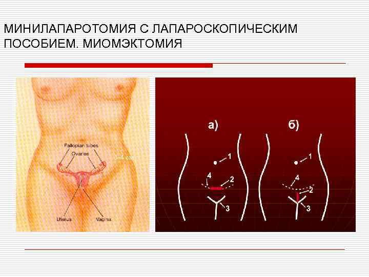 МИНИЛАПАРОТОМИЯ С ЛАПАРОСКОПИЧЕСКИМ ПОСОБИЕМ. МИОМЭКТОМИЯ 3 -4 см 