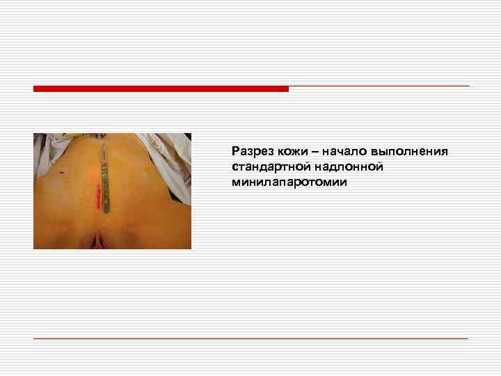 Разрез кожи – начало выполнения стандартной надлонной минилапаротомии 