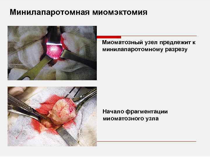 Минилапаротомная миомэктомия Миоматозный узел предлежит к минилапаротомному разрезу Начало фрагментации миоматозного узла 