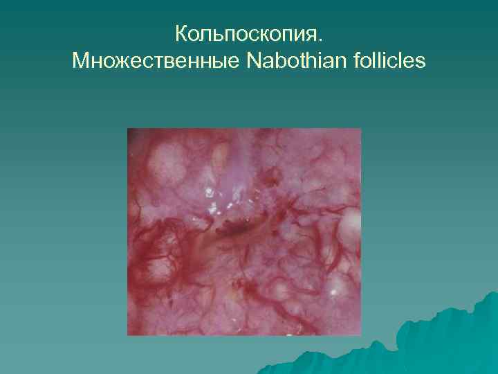 Кольпоскопия. Множественные Nabothian follicles 