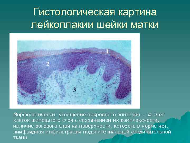 Гистологическая картина лейкоплакии шейки матки Морфологически: утолщение покровного эпителия – за счет клеток шиповатого