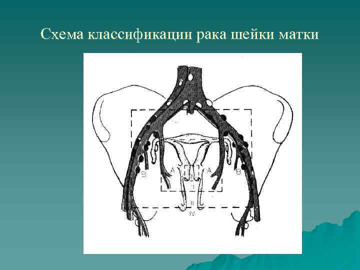 Схема классификации рака шейки матки 