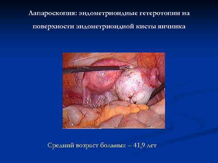Лапароскопия: эндометриоидные гетеротопии на поверхности эндометриоидной кисты яичника Средний возраст больных – 41, 9