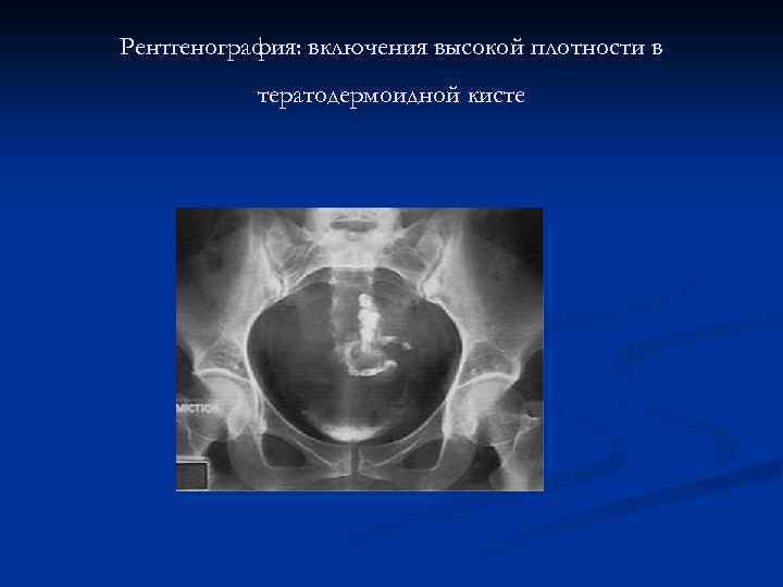 Рентгенография: включения высокой плотности в тератодермоидной кисте 