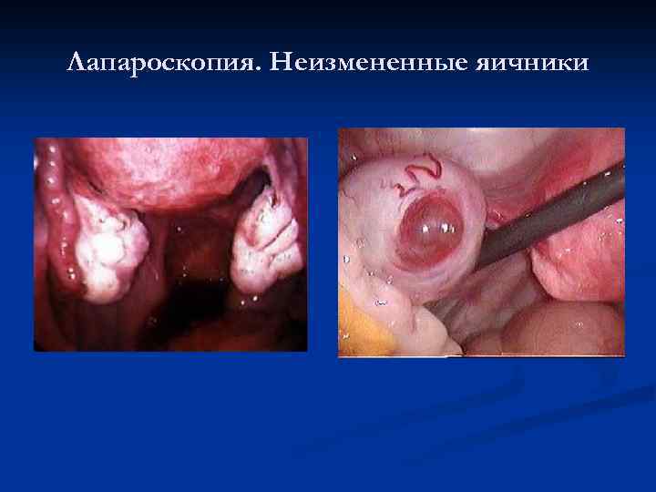 Лапароскопия. Неизмененные яичники 