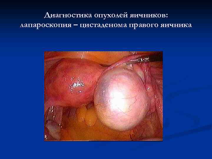 Диагностика опухолей яичников: лапароскопия – цистаденома правого яичника 
