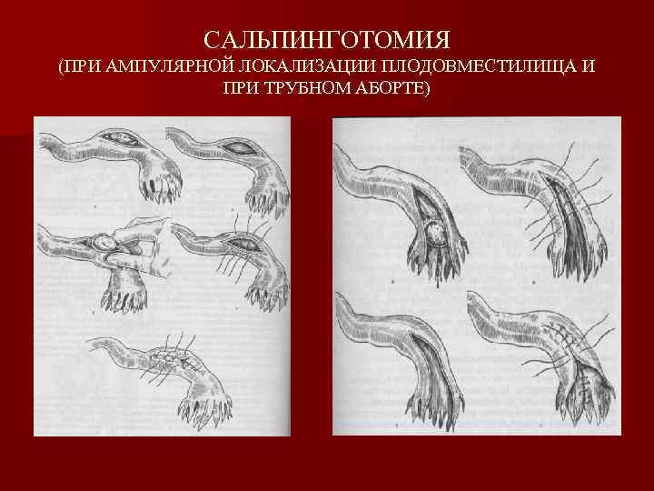 САЛЬПИНГОТОМИЯ (ПРИ АМПУЛЯРНОЙ ЛОКАЛИЗАЦИИ ПЛОДОВМЕСТИЛИЩА И ПРИ ТРУБНОМ АБОРТЕ) 