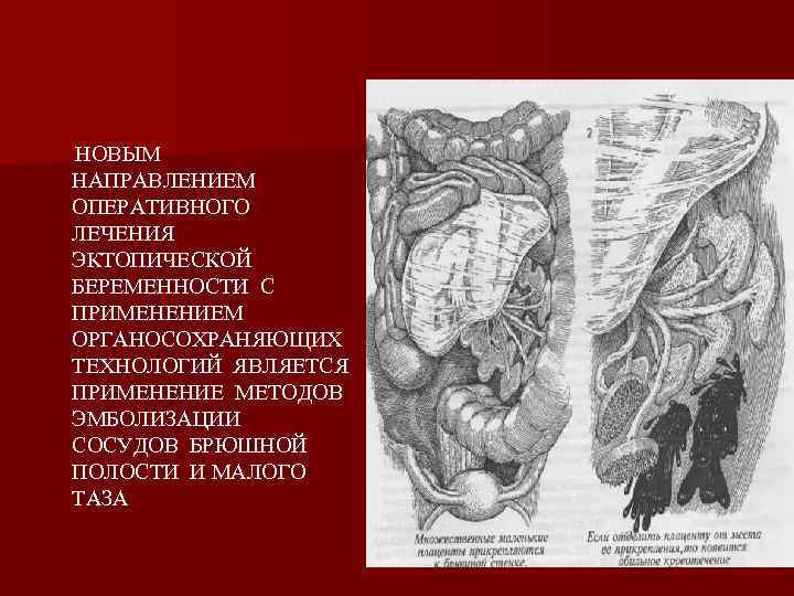 НОВЫМ НАПРАВЛЕНИЕМ ОПЕРАТИВНОГО ЛЕЧЕНИЯ ЭКТОПИЧЕСКОЙ БЕРЕМЕННОСТИ С ПРИМЕНЕНИЕМ ОРГАНОСОХРАНЯЮЩИХ ТЕХНОЛОГИЙ ЯВЛЯЕТСЯ ПРИМЕНЕНИЕ МЕТОДОВ ЭМБОЛИЗАЦИИ