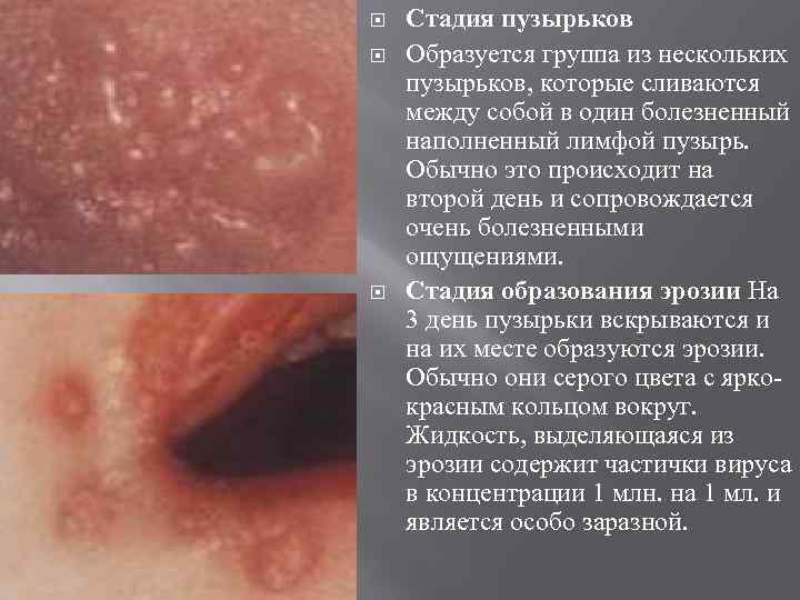  Стадия пузырьков Образуется группа из нескольких пузырьков, которые сливаются между собой в один