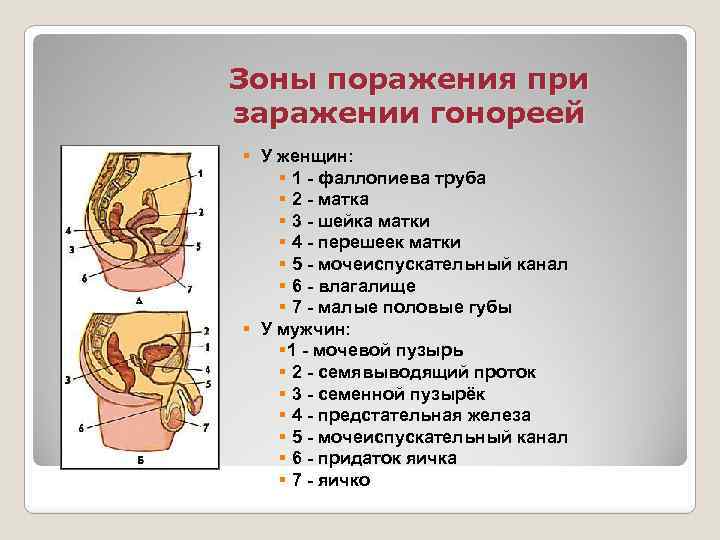 Зоны поражения при заражении гонореей § У женщин: § 1 - фаллопиева труба §