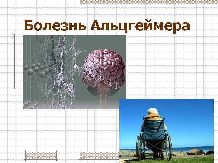 Болезнь Альцгеймера 