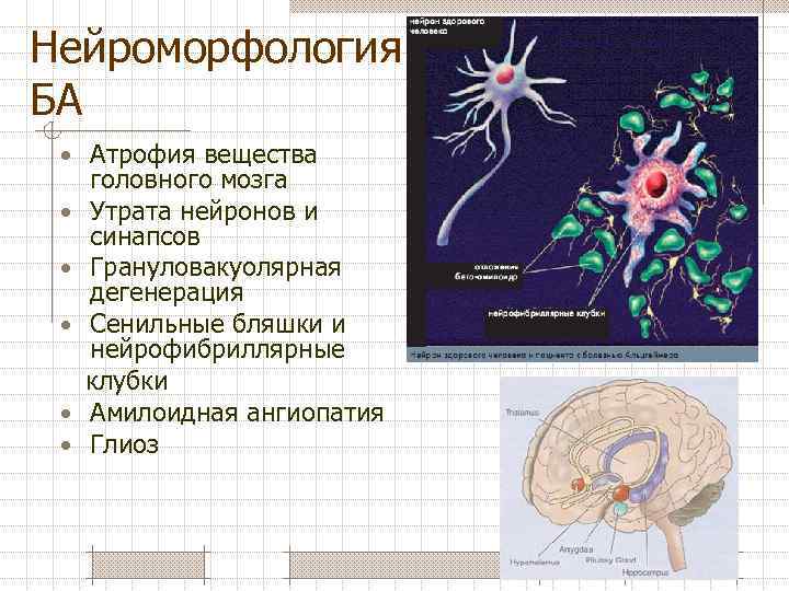 Атрофия вещества головного мозга. Нейроморфология мозга. Болезнь Альцгеймера Нейроны. Нейроны при болезни Альцгеймера. Амилоидные бляшки и нейрофибриллярные клубки.