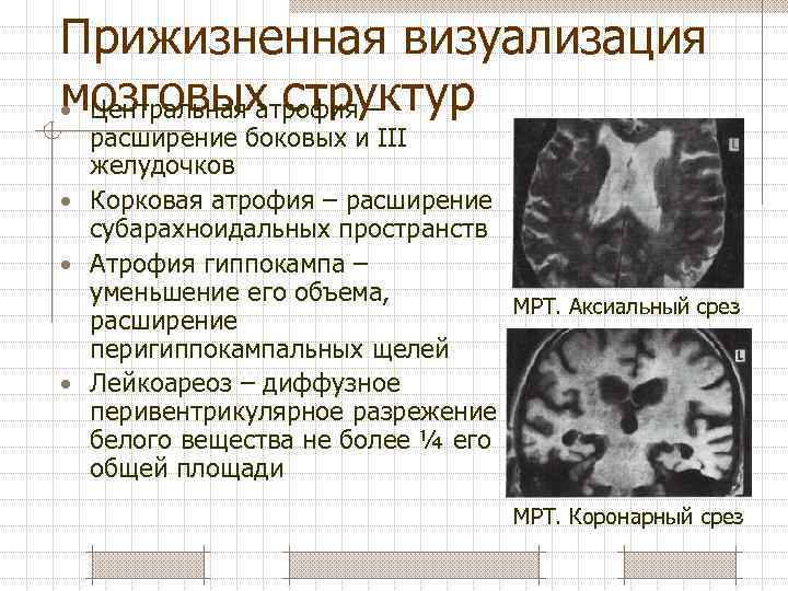 Прижизненная визуализация мозговых структур • Центральная атрофия – расширение боковых и III желудочков •