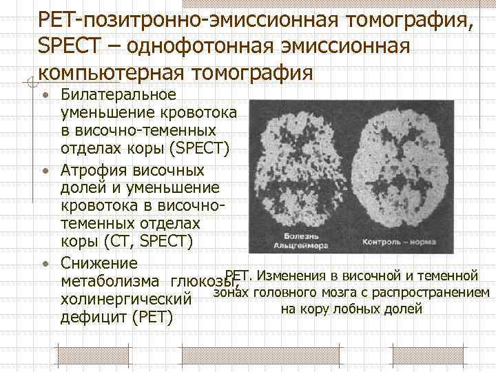 РЕТ-позитронно-эмиссионная томография, SPECT – однофотонная эмиссионная компьютерная томография • Билатеральное уменьшение кровотока в височно-теменных