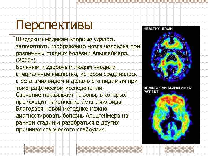 Перспективы Шведским медикам впервые удалось запечатлеть изображение мозга человека при различных стадиях болезни Альцгеймера.